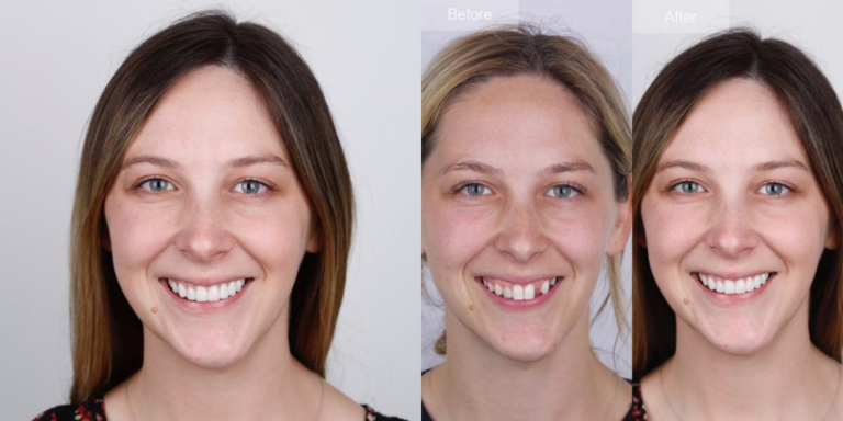 How Subtle Smile Changes Avoid an Over-Treated Look